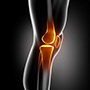 Knee fracture/ORIF